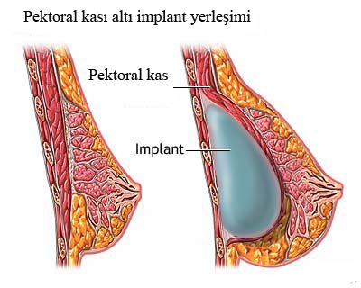 silikon ameliyatı, silikon göğüs