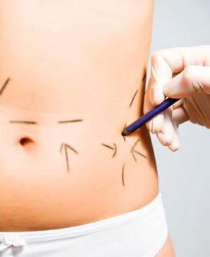 liposuction, yağ alma, liposakşın, yağ aldırma ameliyatı